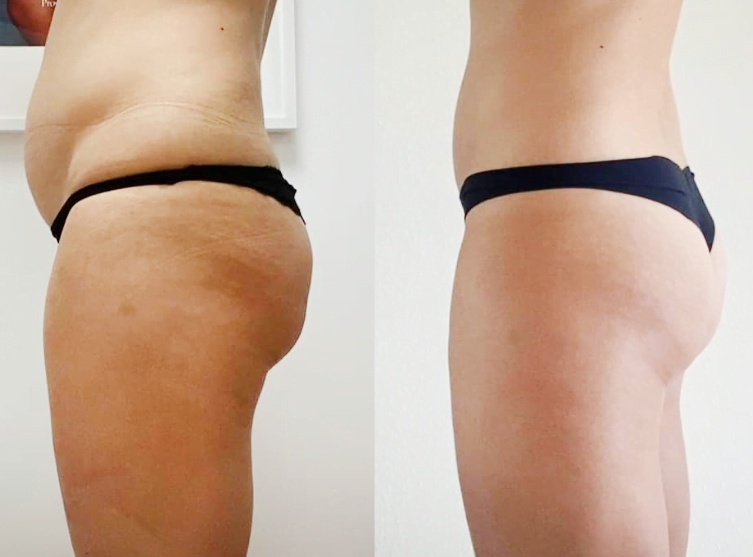Tratamiento reductor Bioslimming en Sofia Mosquera, Milladoiro