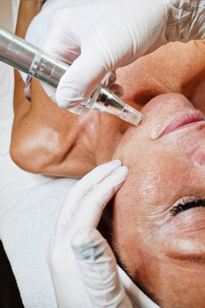 Tratamiento facial microneedling en Sofía Mosquera